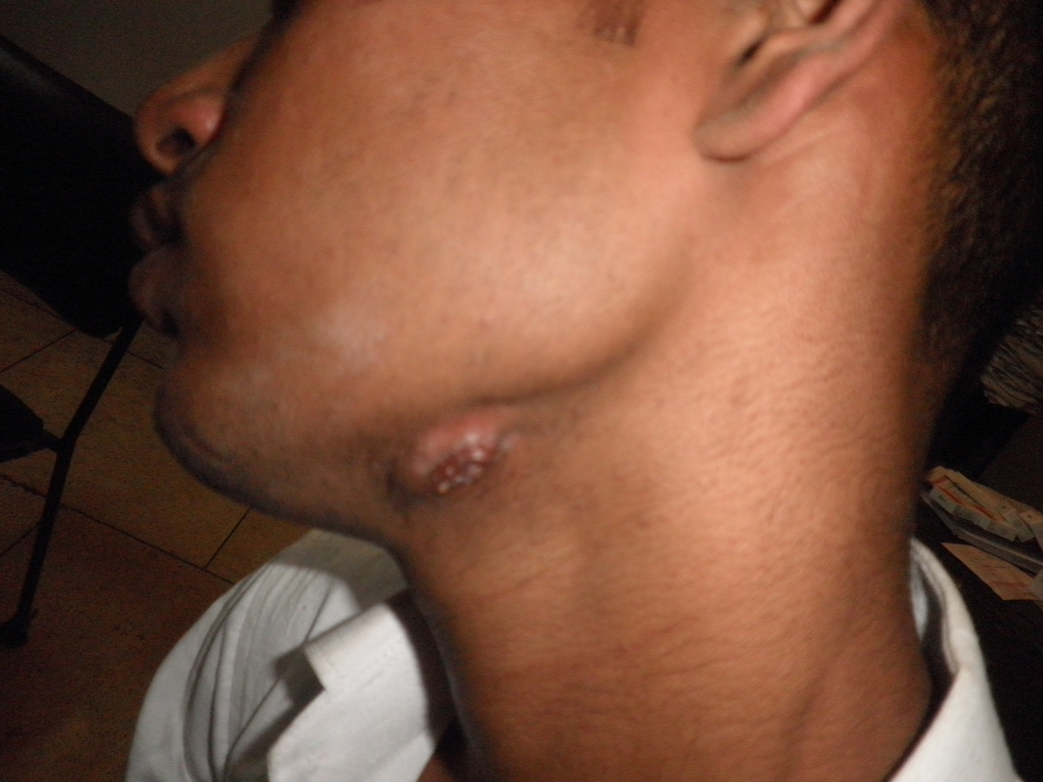 Case Of Submandibular Abscess
