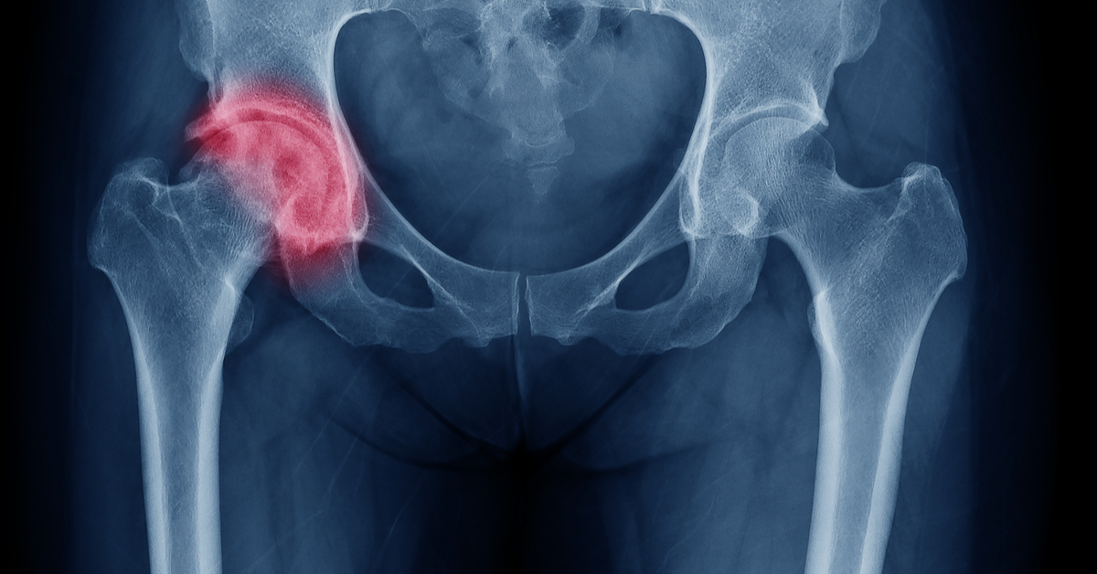 Use PPIs With Caution In Patients At High Risk Of Hip Fractures