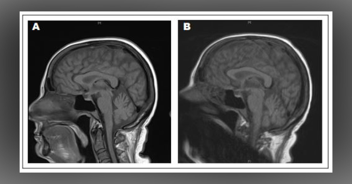 A Rare Complication of AML and MDS
