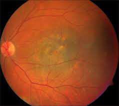 Surgical Modalities Of Choroidal Melanomas