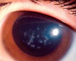 Brief Review On Corneal Dystrophy And Its Classification