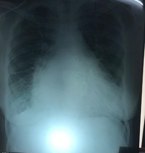What Is Cause Of Cardiomegaly? 