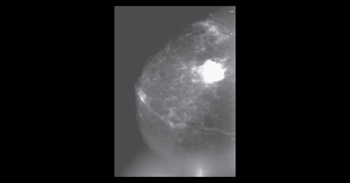 A Female With a Lump in the Breast