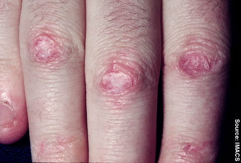 A Dermatology Case - What's Your Diagnosis?