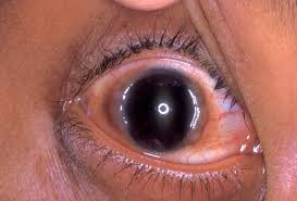Brief Review On Ocular Manifestations Of Vernal Kerotoconjuntivitis