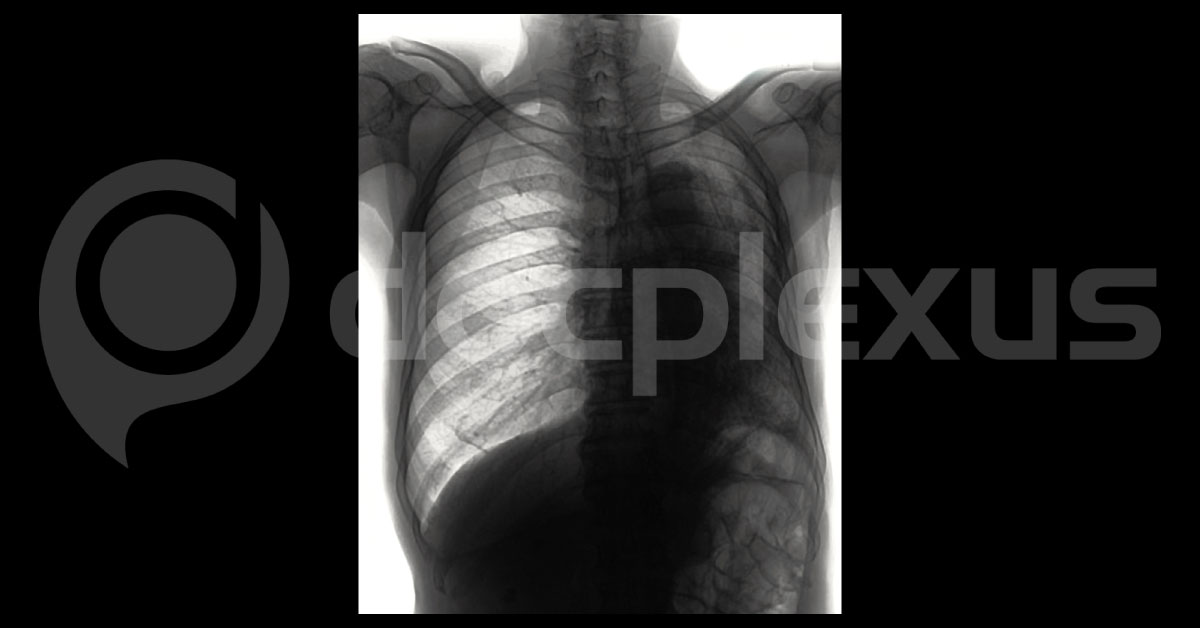New Findings On Pleural Effusion
