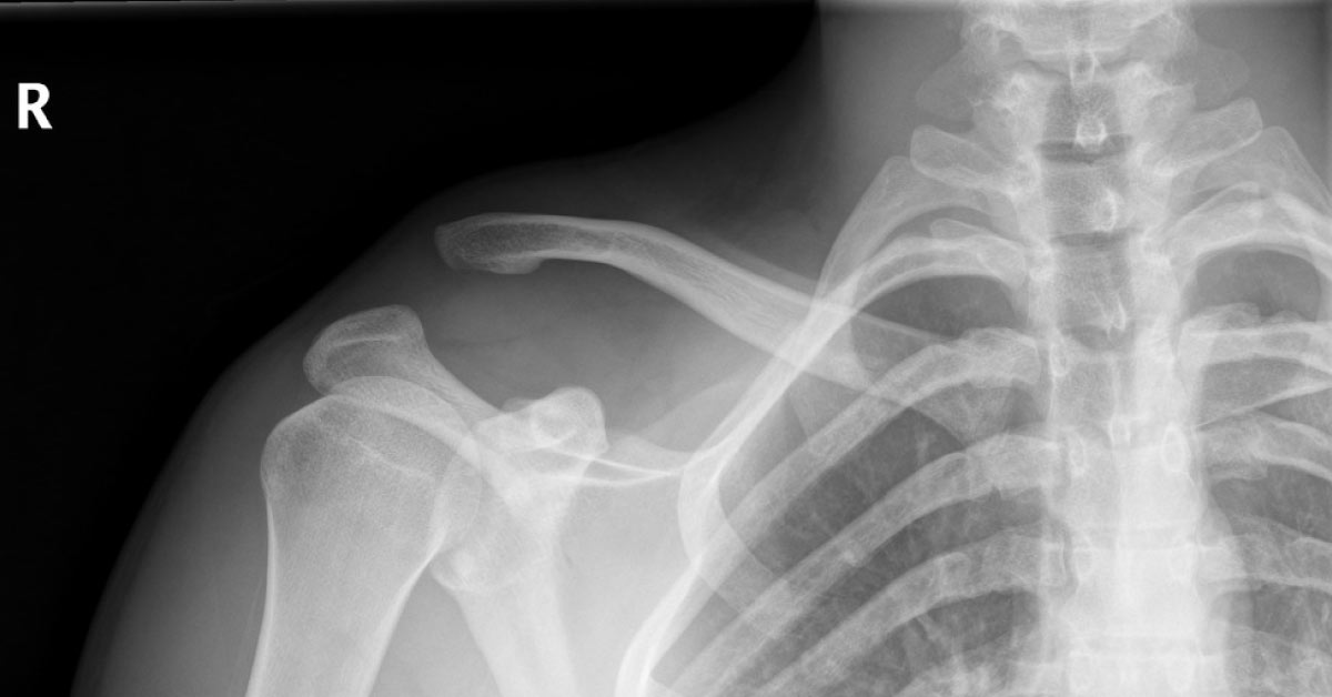 Right Shoulder Pain In A Young Male