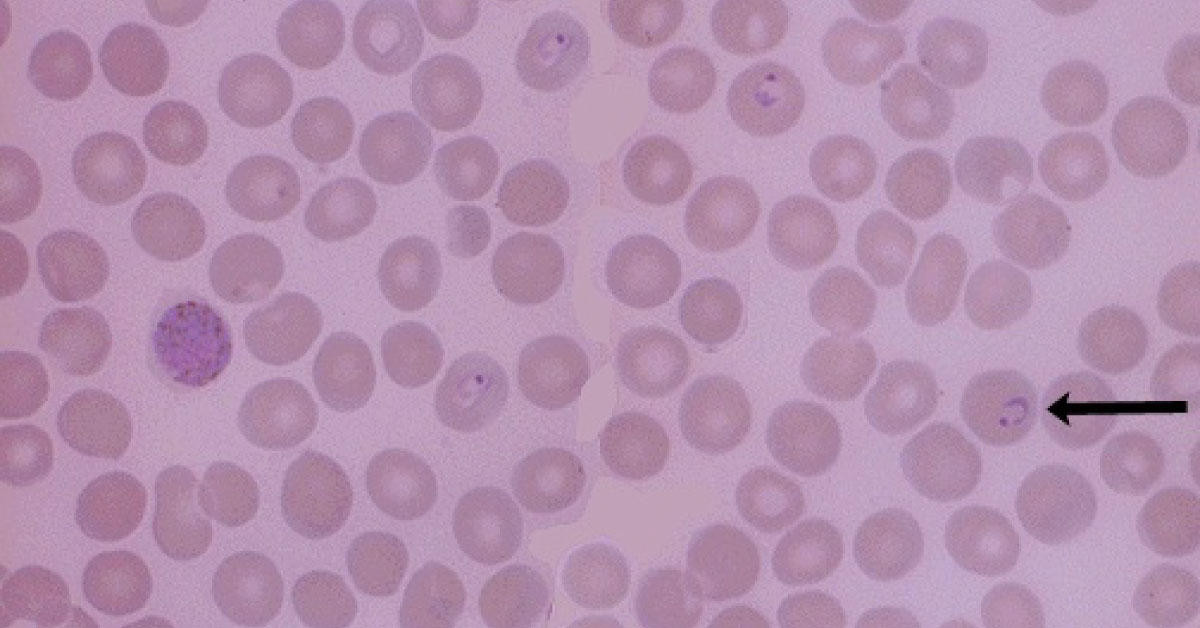 Interpret This Blood Smear
