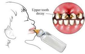 Clinical Practice Guidelines Severe Early Childhood Caries (SECC)