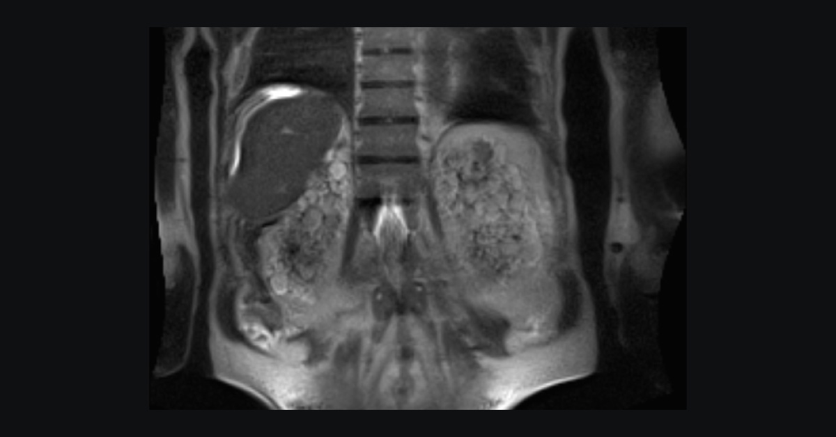 A Case of Renal Failure and Jaundice