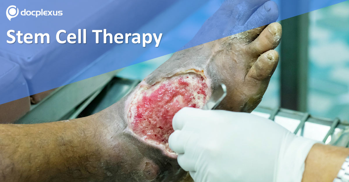 Stem Cell Injections In Diabetic Foot Ulcers