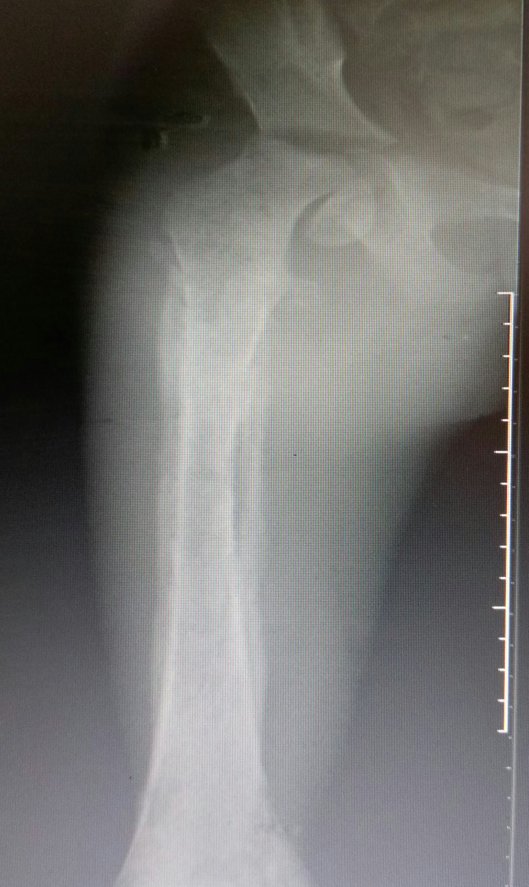 How to Treat Osteomyelitis in this Patient?