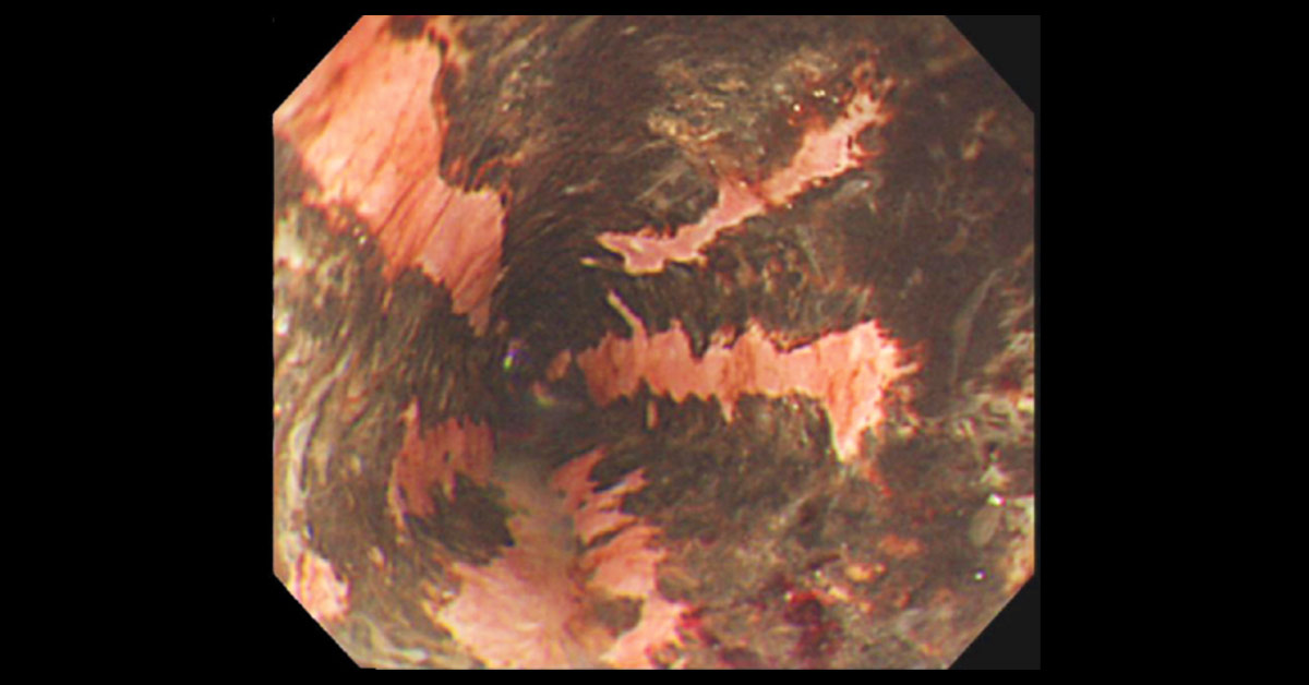 Black Lesions in Esophagus