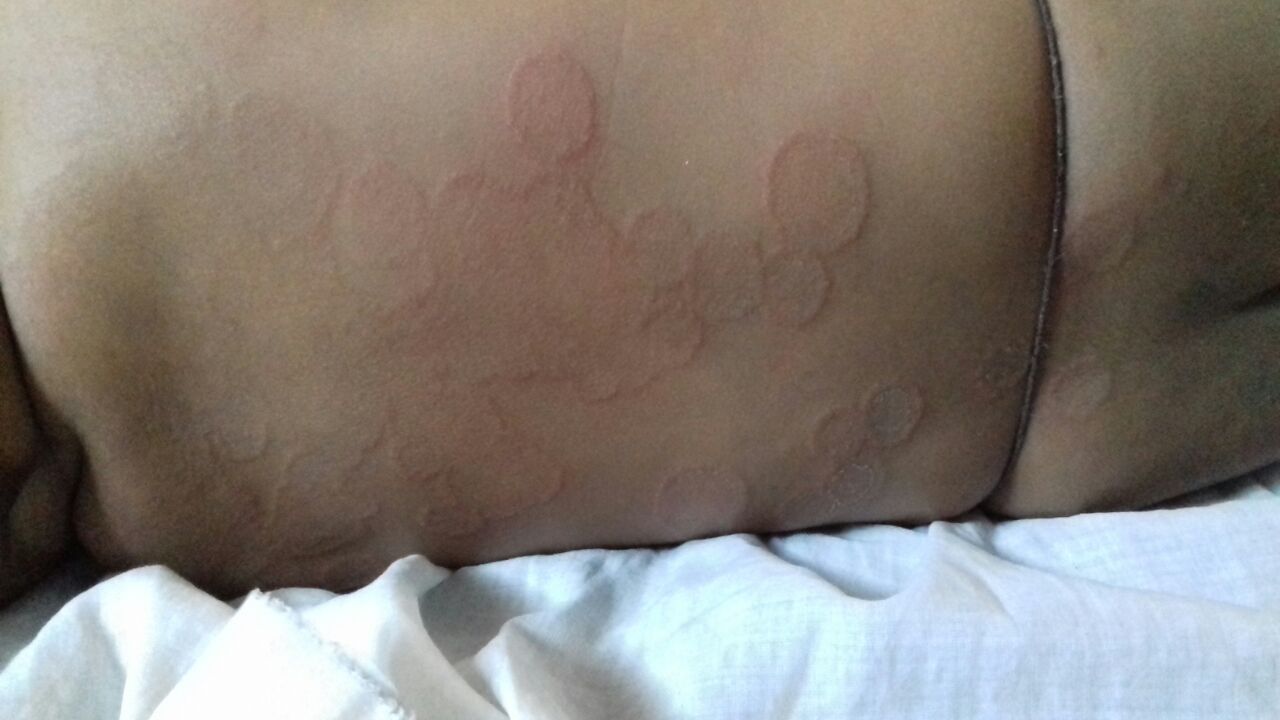 What Is This Rash In 6 Months Old