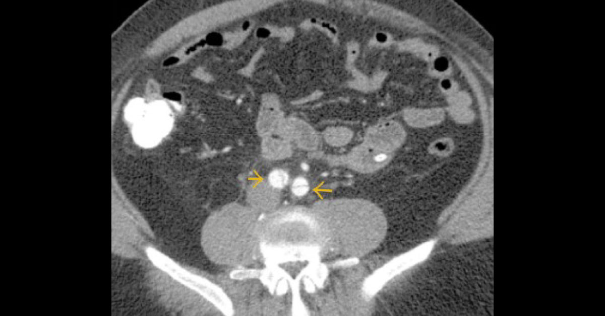 Man with Sudden Epigastric Pain