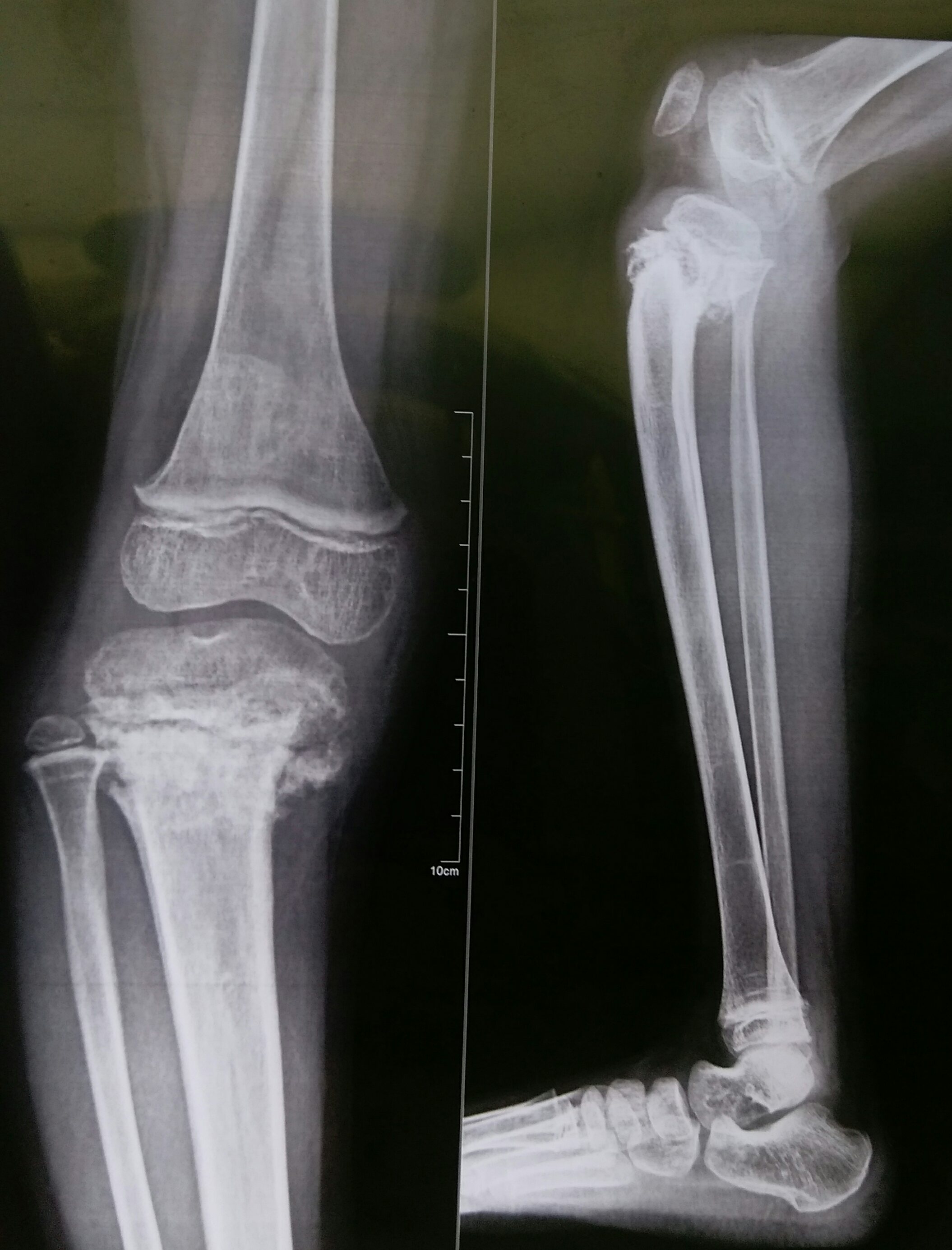 Lesion In Proximal Tibia 