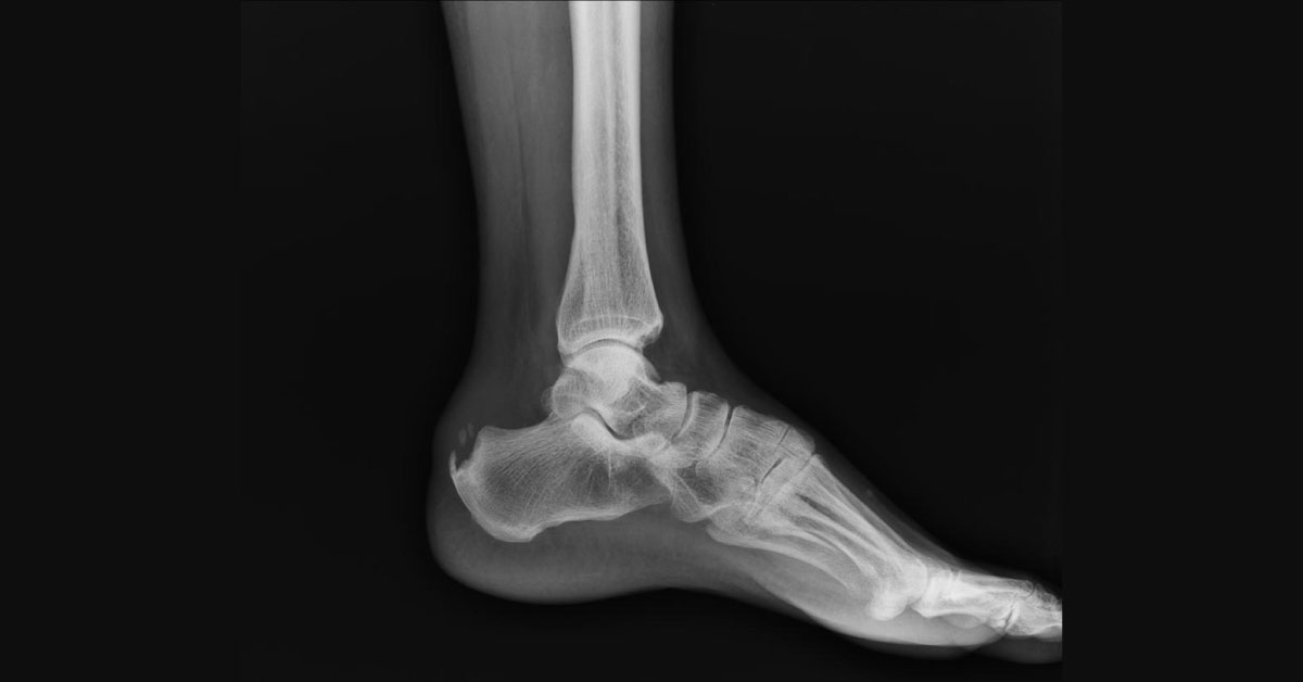 Heel Pain in a Lady