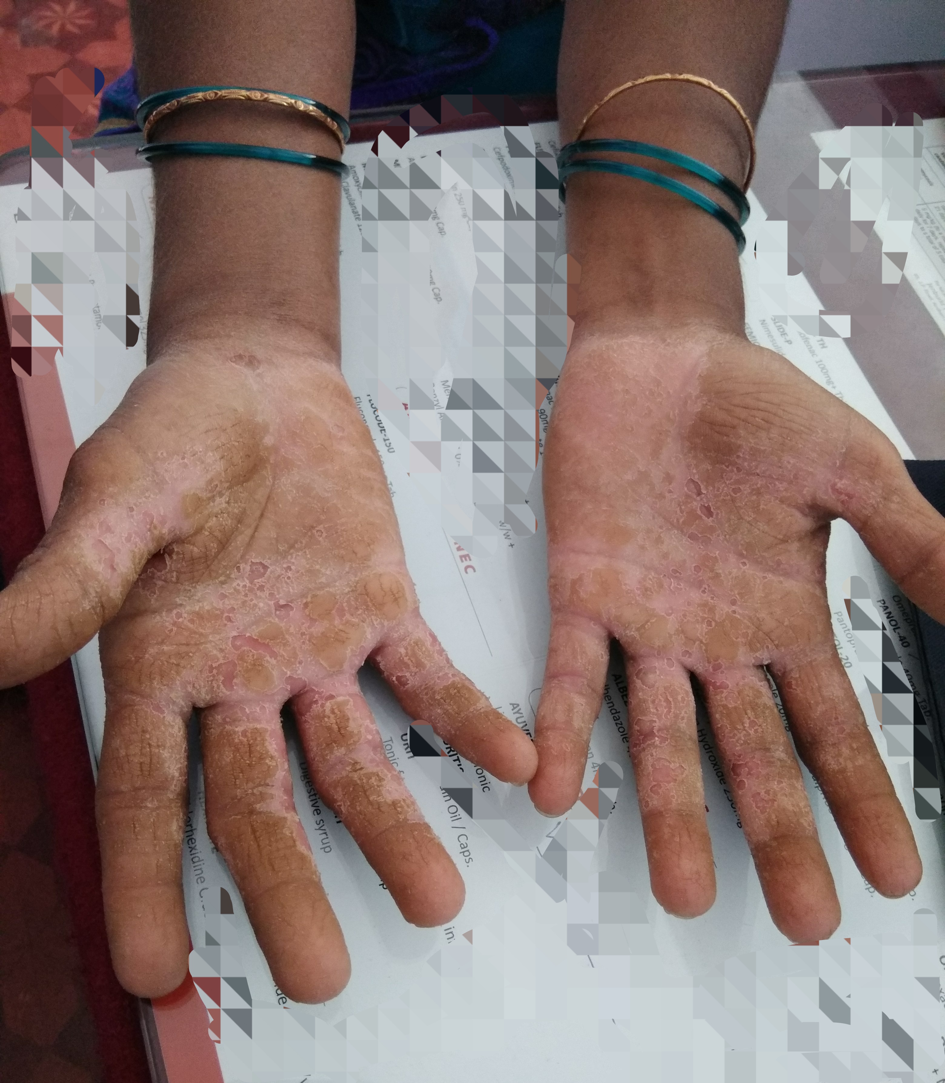 Diagnose The Skin Lesion On Milkmaid's Hands And Foot