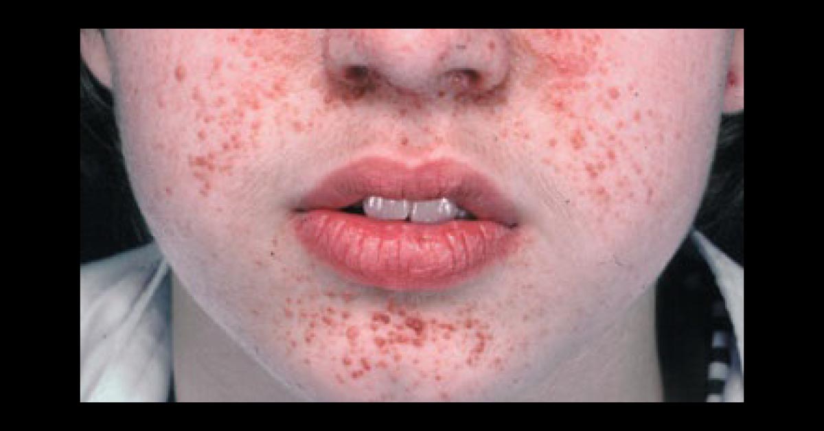 A Boy With Facial Lesions