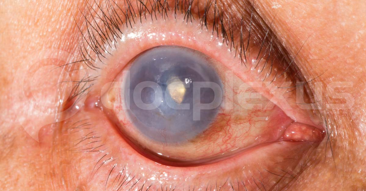 Use Of EDTA In Calcific Band Keratopathy