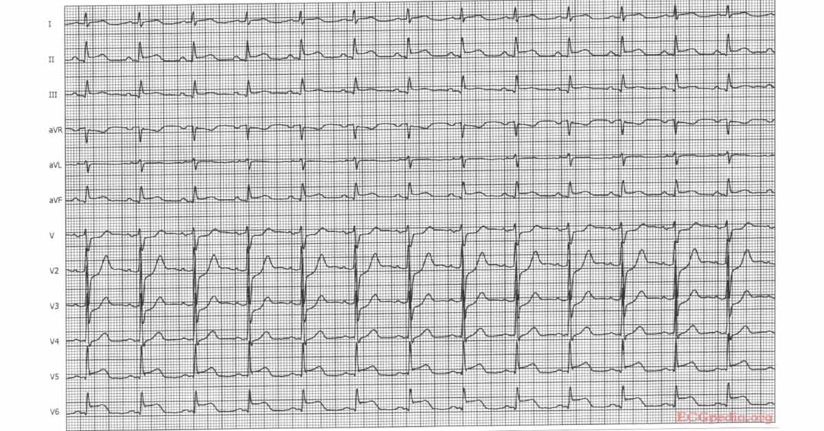 What Do the ECG Findings Reveal?