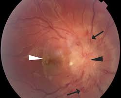 Brief Review On Presentation Of Hydrocephalus
