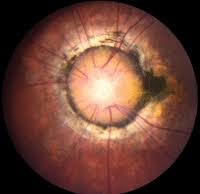 Brief Review On Various Associations Associated With Congenital  Anomalies Of Disc