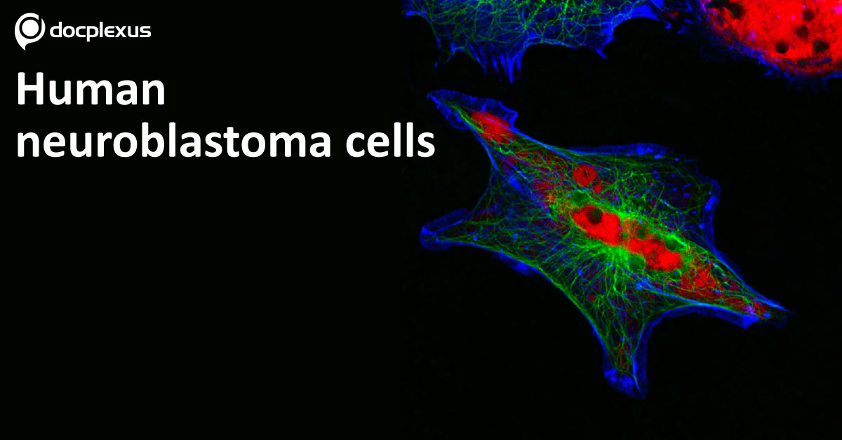 Association of Neuroblastoma with Opsoclonus Myoclonus Syndrome