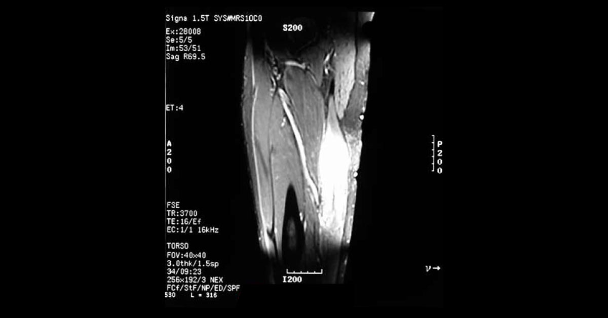 Manage The Mass Enlargement In This Patient