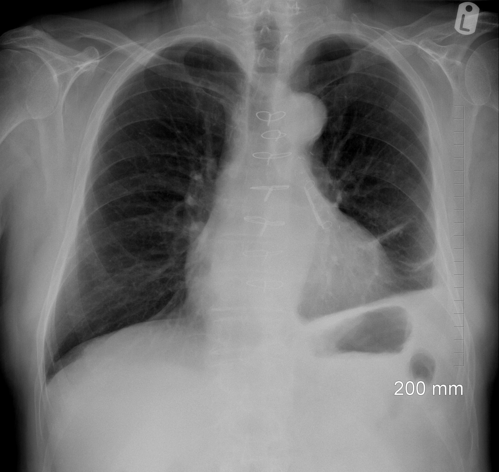 Case of a Man with Chronic Cough