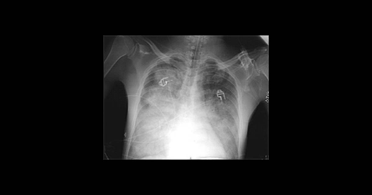 Diagnose This Pulmonary Case