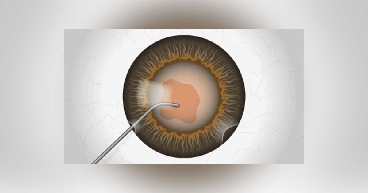 Criteria For IOL Implantation