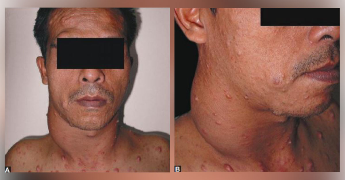 Patient with Skin Swelling and Neck Lump