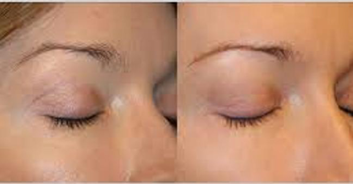 Who Should Do An Oculoplsatic Surgery?