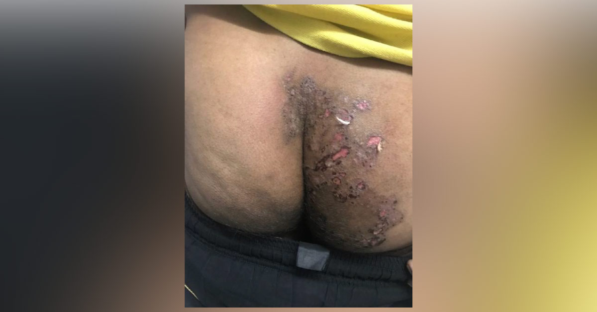 No Relief For A Patient With Excoriated Skin Lesions