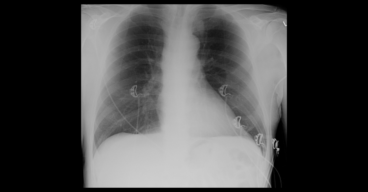 Case of a Patient with Chest Pain