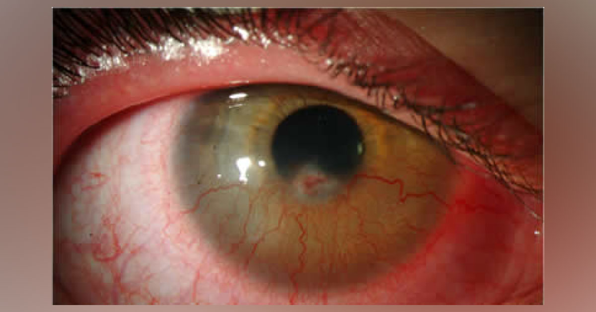 Diagnose the ophthalmic abnormality?