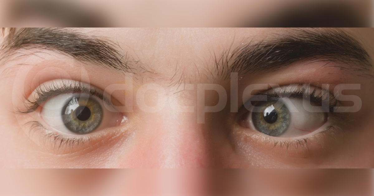 Brief Review On Type F Anesthesia In Squint Surgery