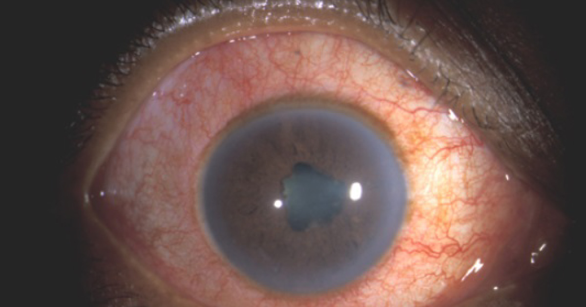 A Case of Photophobia and Ocular Pain
