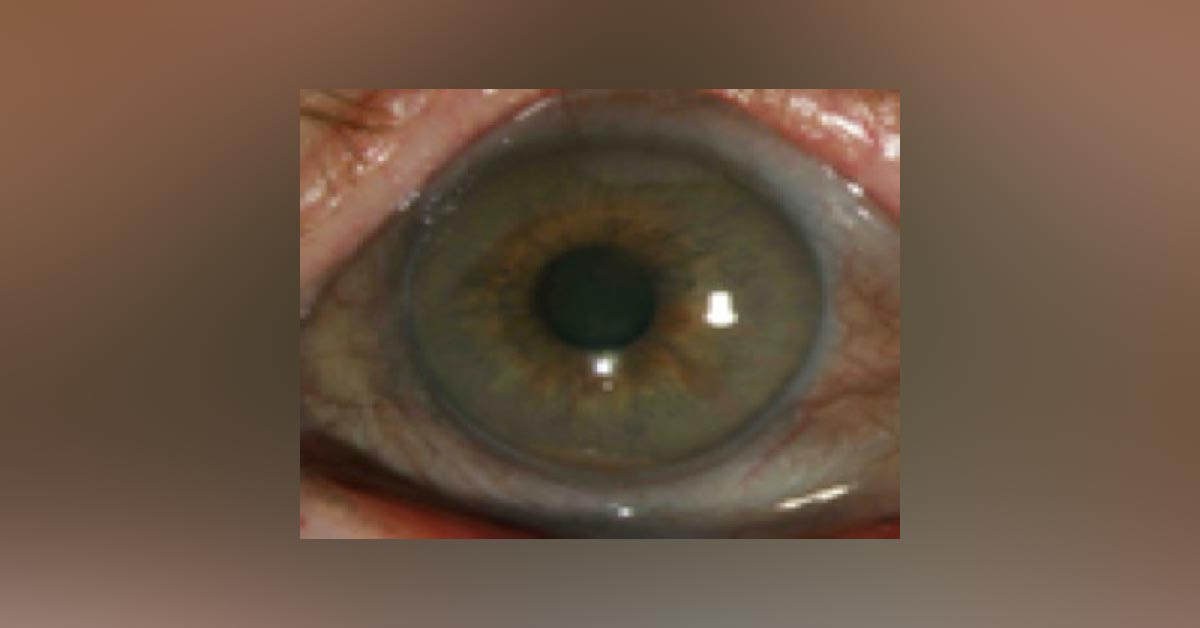 What Is the Most Likely Cause of Pigmentation in This Case?