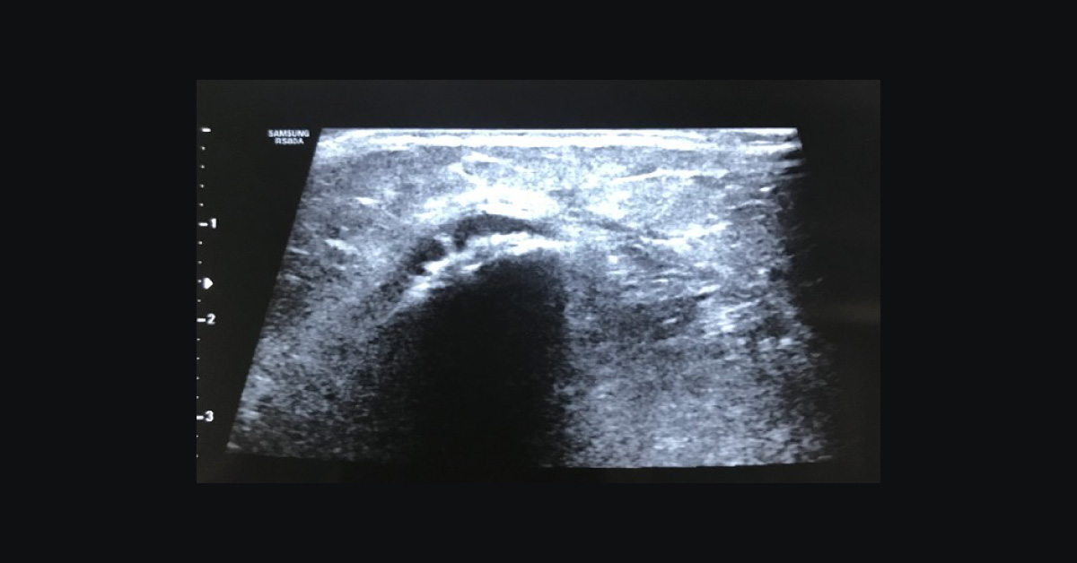 Swelling at the Level of Tibia