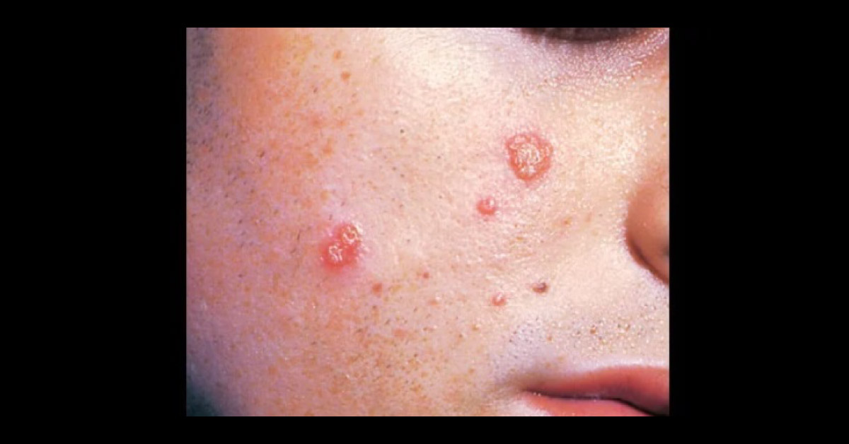 Identify This Infectious Condition