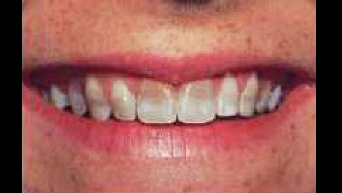 Discoloration Of Teeth In A Middle Aged Man
