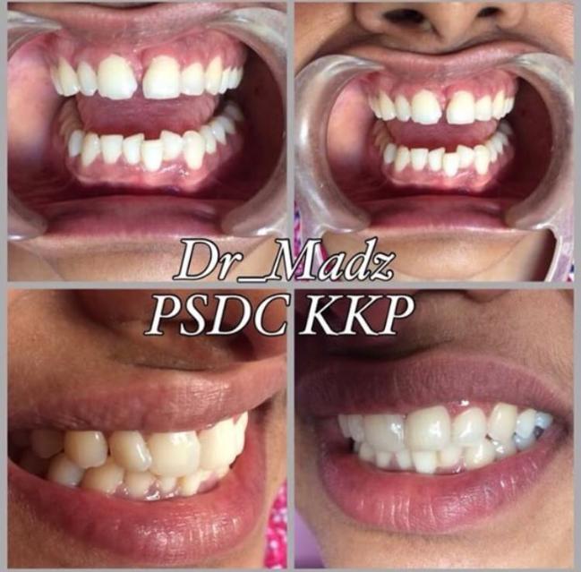 Diastema Closure With Composite Restoration