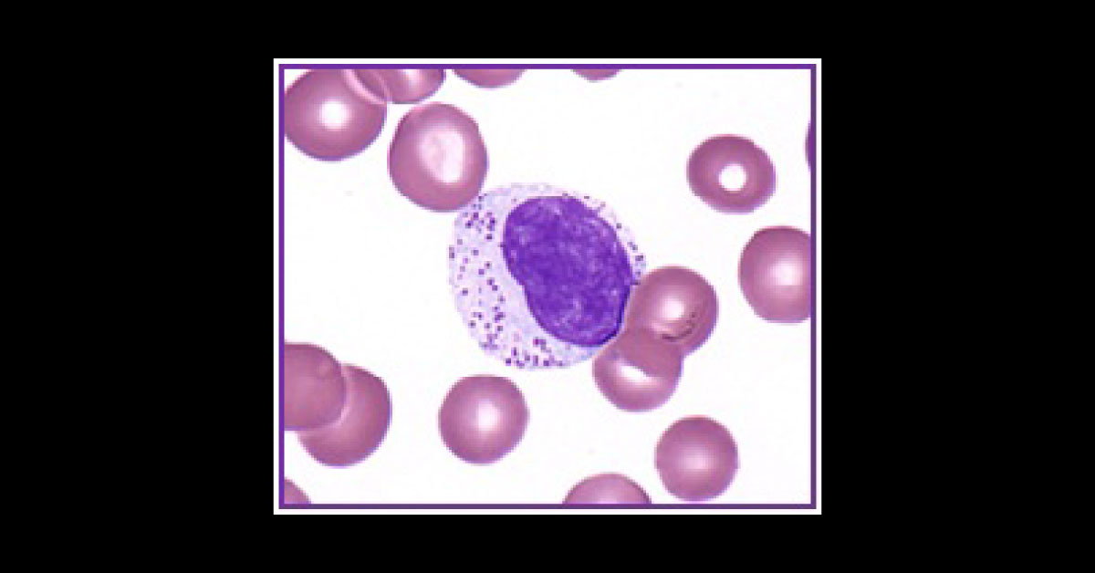 Case of a Woman with Neutropenia and Splenomegaly