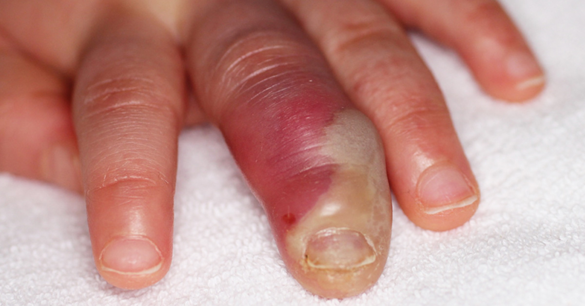 Identify the Cause of Erythema