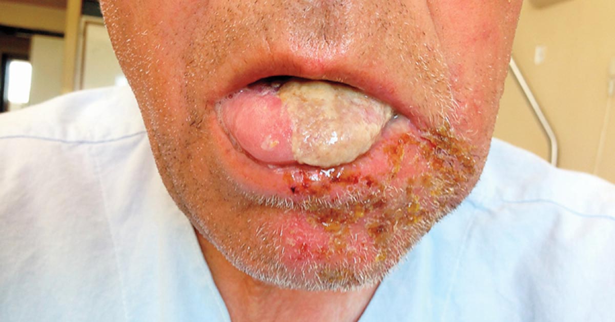 An Old Man with Facial Edema