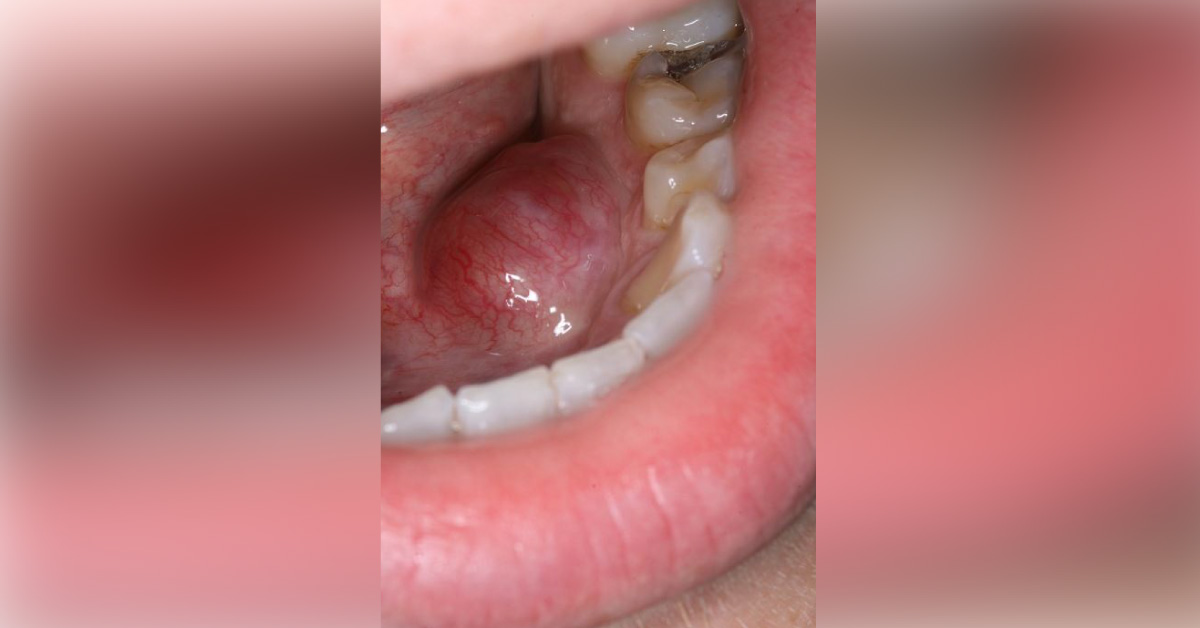 Case of a Young Man with a Large Swelling in the Left Floor of His Mouth