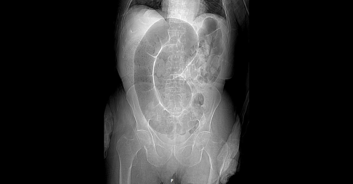 A Man With Abdominal Distension