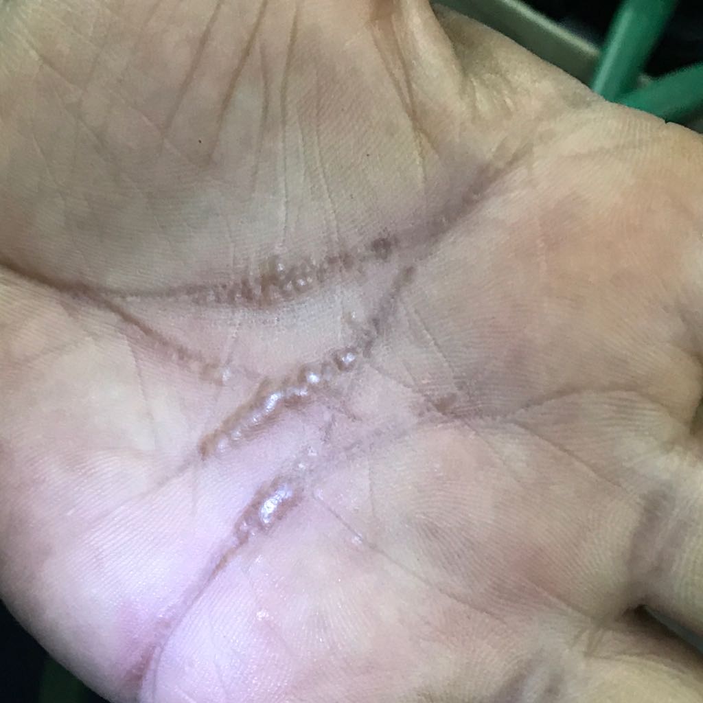 Diagnose These Tiny Nodular Lesions Over Palm